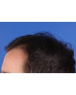 Before Hair Transplant &nbsp;Hairlines
